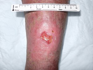 leg ulcer